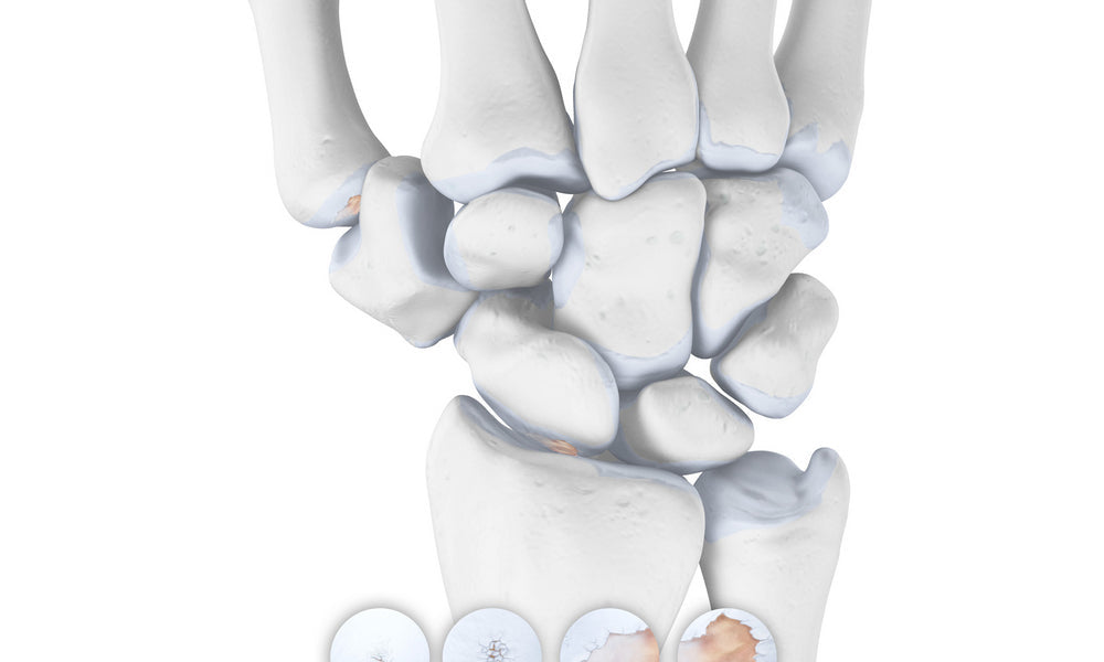 Wrist Osteoarthritis - Arthritis in the Wrist Joint