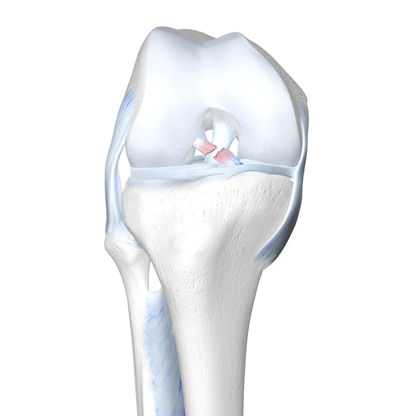 Cruciate Ligament Tear