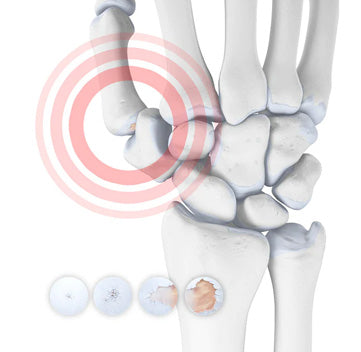 Arthritis of the Thumb