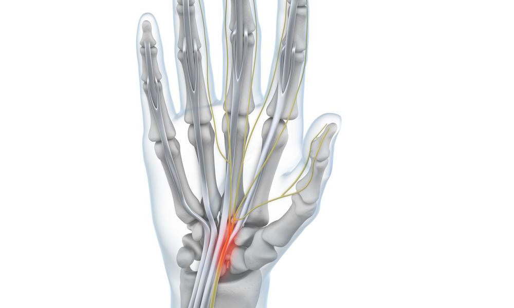 Carpal Tunnel Syndrome (CTS)