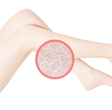 Dry Skin in Compression Stockings
