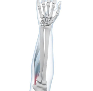 Golfers Elbow & Arm