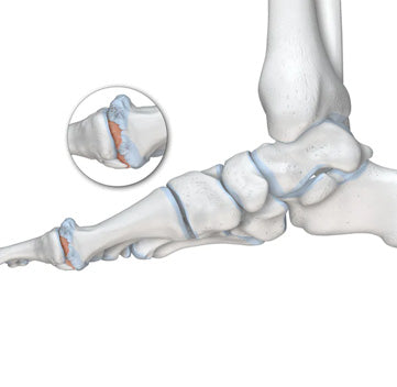 Hallux Rigidus - Arthritis of the Big Toe