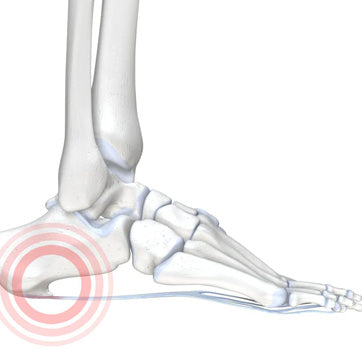 Heel Spurs - Bony Overgrowth of the Heel Bone