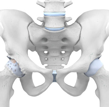 Hip Rast Hip Arthritis: Osteoarthritis of the Hip Joint