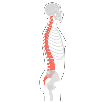 Hyperkyphosis and Dowager's Hump