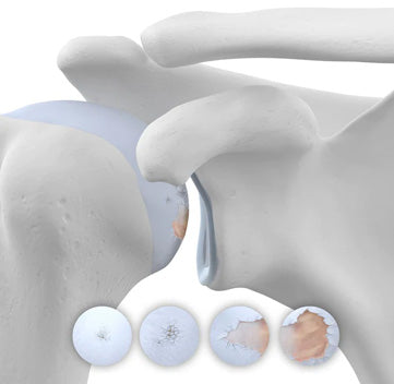 Shoulder Osteoarthritis