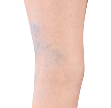 Spider Veins