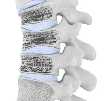 Spinal Osteoporosis