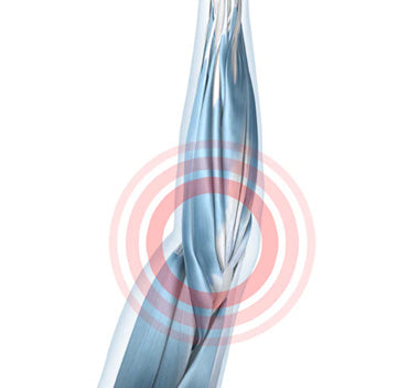 Tendon Attachment Irritation