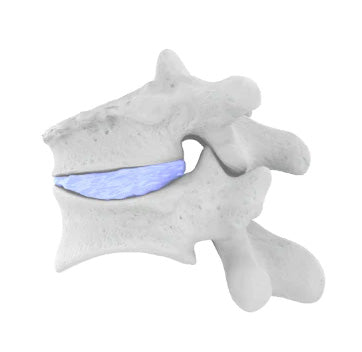 Vertebral Compression Fractures