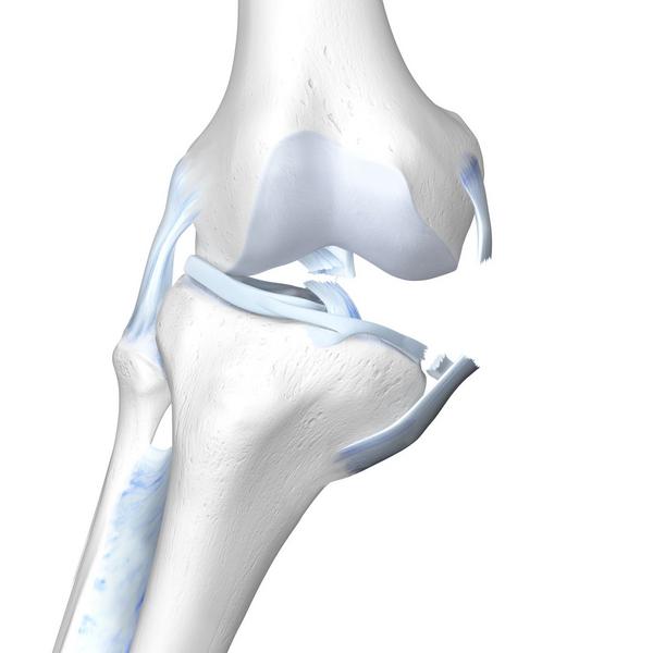 Unhappy Triad - ACL, MCL, & Meniscus Damage