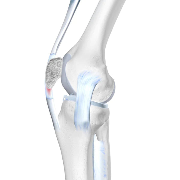 Pain And Irritation In The Patellar Tendon