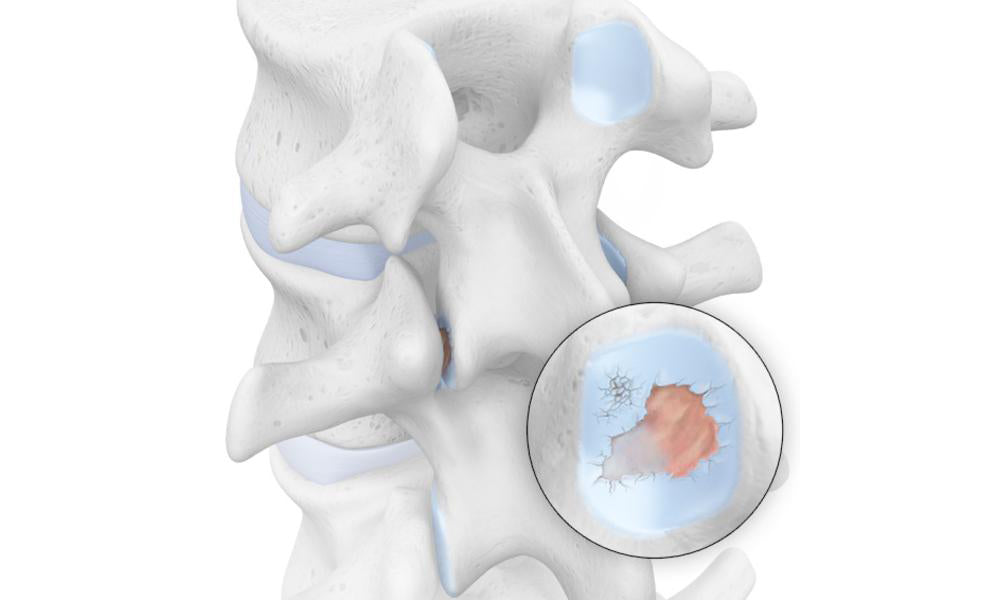 Spondyloarthritis - Arthritis of the Spine